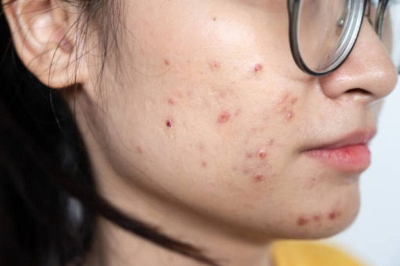 Top 6 Healing Foods for Inflamed Skin