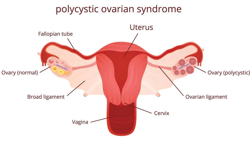 What is Polycystic Ovary Syndrome (PCOS)