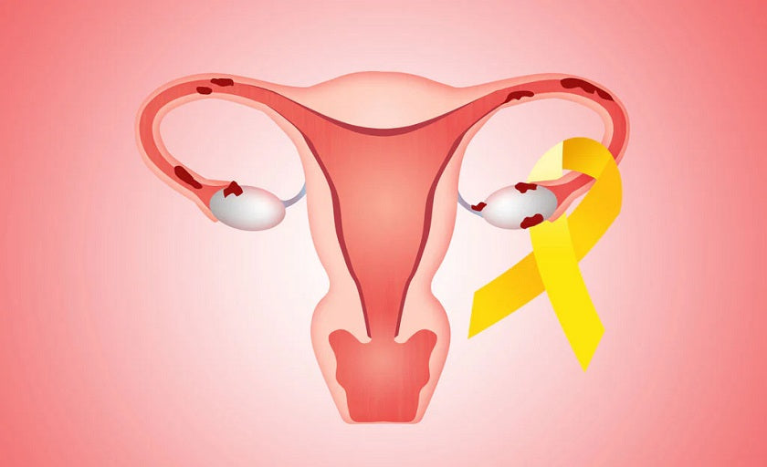 9 Steps to Treating Endometriosis Naturally