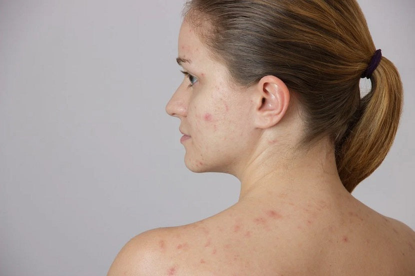 Can PCOS Cause Acne?