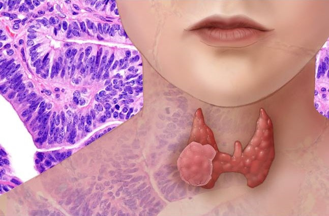 Thyroid Health: A Holistic Naturopathic Perspective