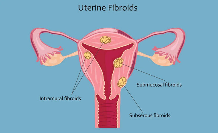 Fibroids: A Comprehensive Guide | Happy Healthy You